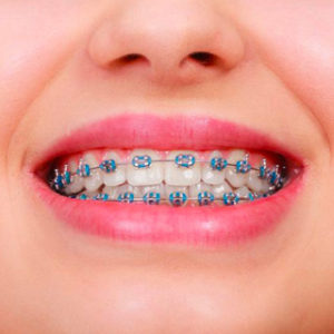 img-ortho-braces-metal