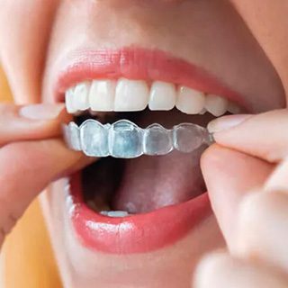 img-treatmentoption-invisalign