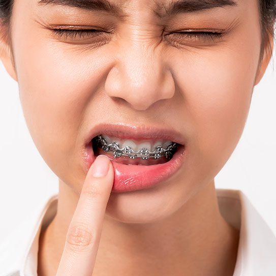 braces pain